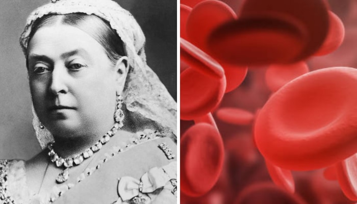 World Hemophilia Day : इंग्लंडच्या विक्टोरिया राणीला जीवघणे आजाराची लागण, रक्ताचं होतं पाणी, असे होतात हाल 