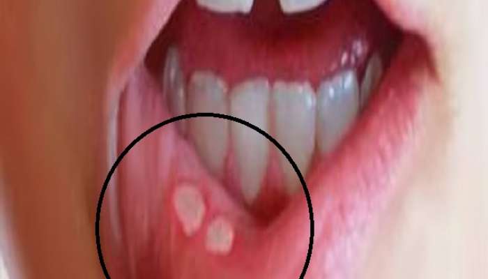  उष्णतेमुळे तोंडात अल्सर येत आहेत का? मग करा हे उपाय