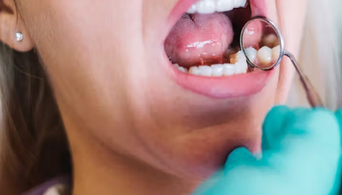 Oral Cancer: तोंडाच्या कर्करोगाशी संबंधित कोणत्या गैरसमजूती मनात असतात? जाणून घ्या