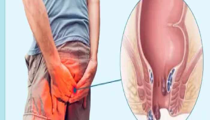 Bloody Piles Treatment : मूळव्याधचा त्रास होतोय? स्वयंपाकघरात असलेली 'ही' पिवळी गोष्टी दूर करेल समस्या 
