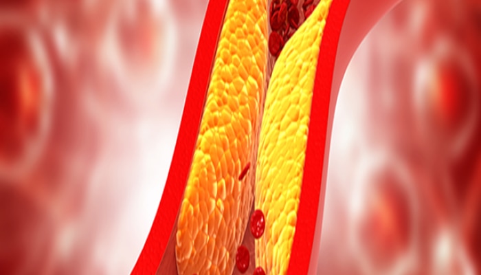 'ही' 7 लक्षणं म्हणजे नसांमध्ये भरपूर चरबी, उच्च कोलेस्ट्रॉलची धोक्याची घंटा