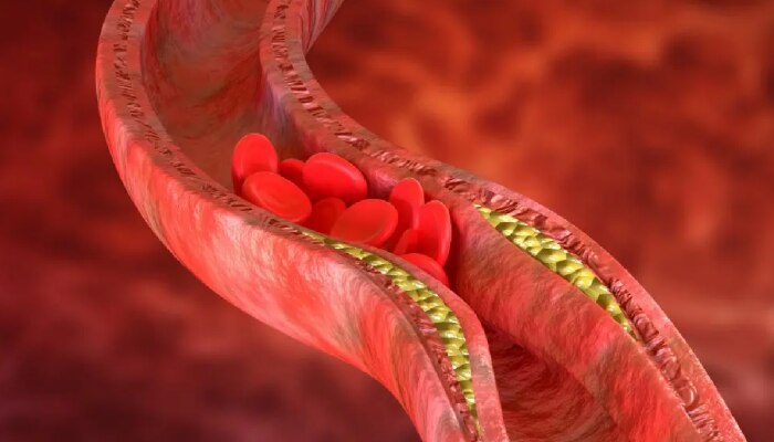 High cholesterol: कोलेस्ट्रॉल वाढल्यानंतर शरीरात लगेच दिसतात &#039;हे&#039; बदल; वेळीच लक्ष द्या अन्यथा...!