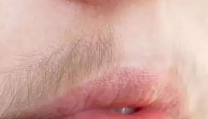 Use  simple trick to remove unwanted facial hair