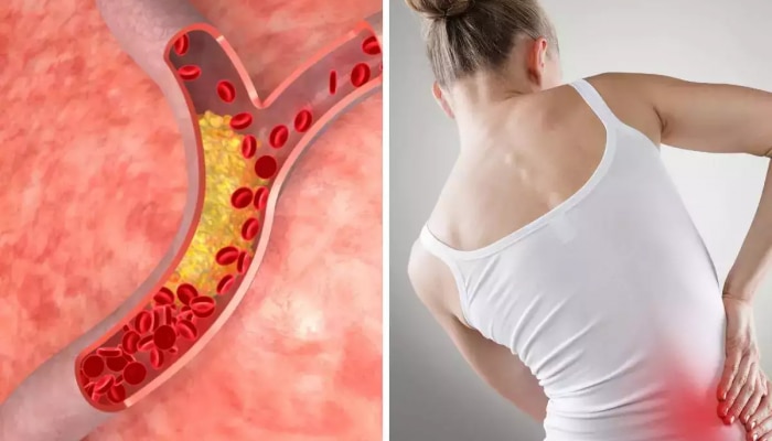 Symptoms Of High Cholesterol: कोलेस्ट्रॉल वाढल्यानंतर शरीराच्या &#039;या&#039; भागांमध्ये होतात तीव्र वेदना; अजिबात दुर्लक्ष करू नका!