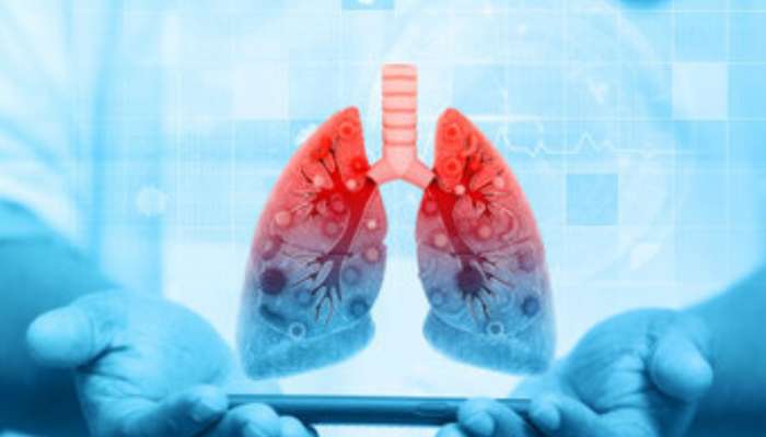 Lung Cancer Symptoms: सामान्य वाटणाऱ्या लक्षणांकडे करु नका दुर्लक्ष, फुप्फुसाचा कॅन्सर ठरतोय जीवघेणा, पाहा लक्षणे