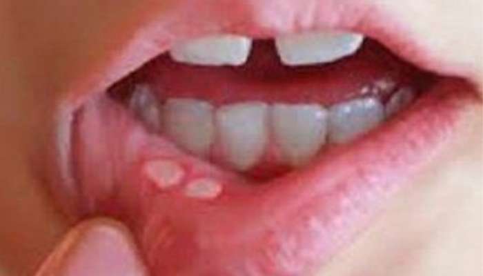 Mouth Ulcer: तोंड आलंय, फोडांमुळं अन्न खातानाही त्रास होतोय? हे&#039; घरगुती उपाय क्षणात देतील आराम