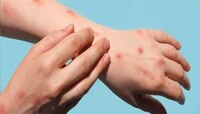 भारतात Monkeypox चा धोका आहे का? केंद्र सरकारने स्पष्टच सांगितलं