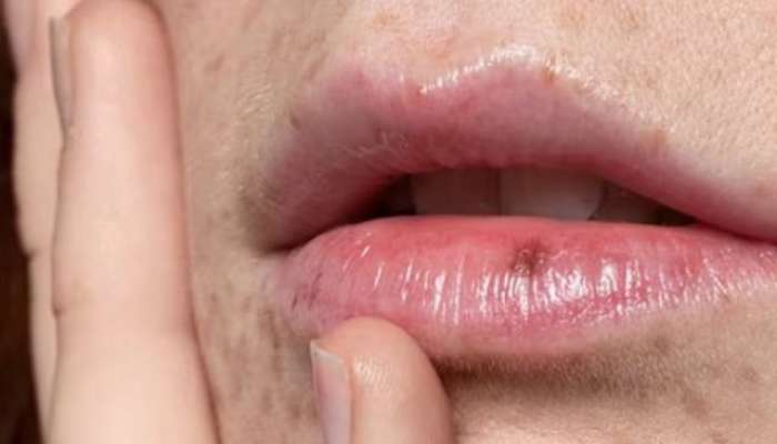 Chapped lips, dry and cracked lips treatment, due to which vitamin people have chapped lips, honth fatne ke karan, vitamins can be beneficial for lips, Which vitamin is responsible for chapped lip