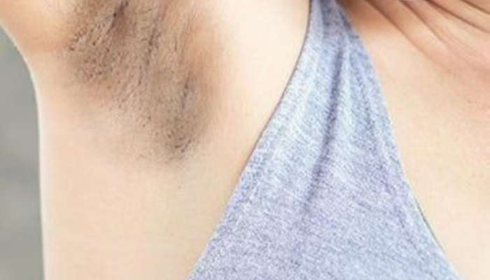 how to get rid of black underarms at home