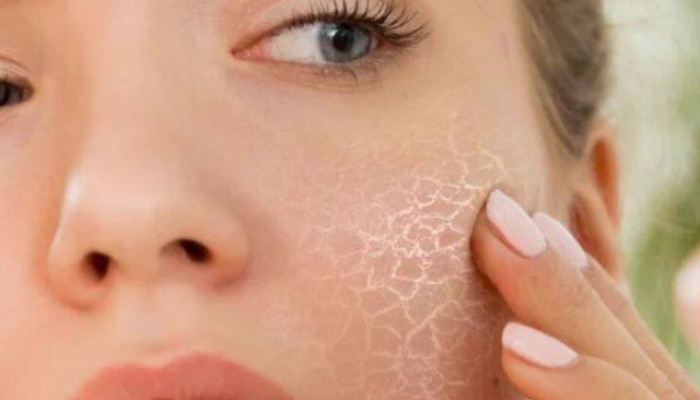 Dry skin problem in winter follow follow homemade tips to get hydrated