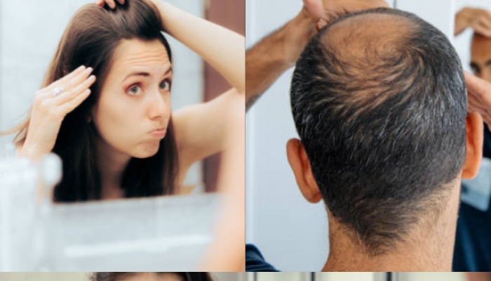 Hair loss in early adulthood 5 reasons Health Marathi News