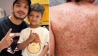 मुनव्वर फारुकीच्या मुलाला झालेला कावासाकी आजार नेमका आहे तरी काय? जाणून घ्या लक्षणं 