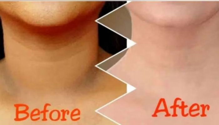 Try these home remedies for tan and black neck  