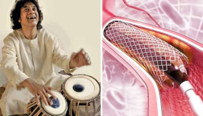 Zakir Hussain: हृदयात लावले होते 'स्टेंट', 'या' जीवघेण्या आजाराशी झुंज देत होते झाकिर हुसेन