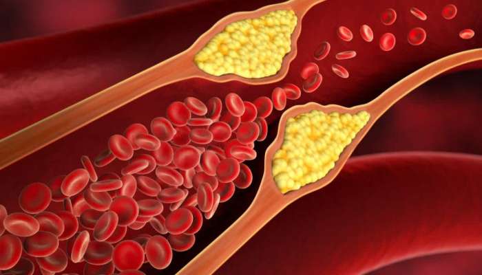 नसांमध्ये साचलेले घाणेरडे कोलेस्ट्रॉल खेचून बाहेर काढतील हे &#039;5&#039; पदार्थ; तुमच्या किचनमध्येच आहे उपाय