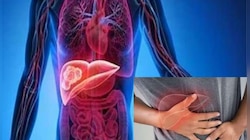 लिव्हर कॅन्सरच्या रुग्णांसाठी गूड न्यूज; शस्त्रक्रियेविना होणार उपचार 