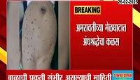 अमरावतीच्या मेळघाटात अंदश्रद्धेचा कळस; 22 दिवसांच्या बाळाला 65 चटके