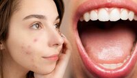 सकाळी तोंडातील लाळ मुरुमांवर लावल्याने खरंच फायदा होतो? जाणून घ्या तज्ज्ञांचं मत