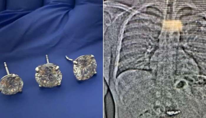 660000000 चे डायमंड इअररिंग्स चोरी करुन गिळले; 12 दिवसांनी काय घडलं पाहा