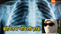झोपेत कूस बदलताना महिलेची तुटली हाडं; X Ray पाहताच डॉक्टर चक्रावले 