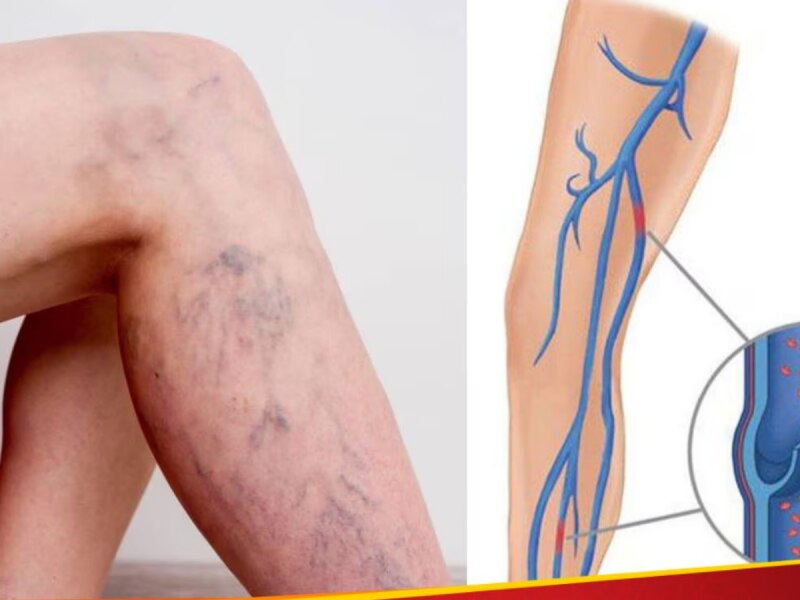 अचानक आपल्या नसांचा रंग का बदलतो? जाणून घ्या हा आजार कोणत्या लोकांमध्ये दिसून येतो