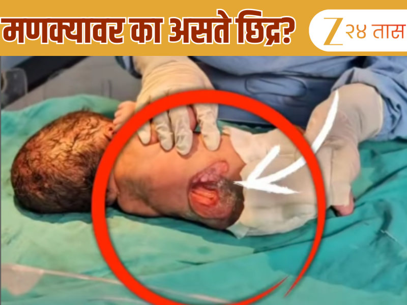 जन्मतःच बाळाच्या पाठीवर छिद्र; आईच्या एका चुकीमुळे नवजात बाळाची 'ही' अवस्था; डॉक्टरांनी सांगितलं कारण 