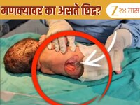 जन्मतःच बाळाच्या पाठीवर छिद्र; आईच्या एका चुकीमुळे नवजात बाळाची 'ही' अवस्था; डॉक्टरा