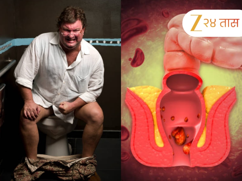 बद्धकोष्ठतेचाच त्रास होतोय, हे कसं ओळखाल? डॉक्टरांनी सांगितलं Constipation झाल्यास द