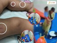 मुलांना Day Care मध्ये ठेवण्याआधी विचार करा! 15 महिन्याच्या बाळाची काय अवस्था झाली प