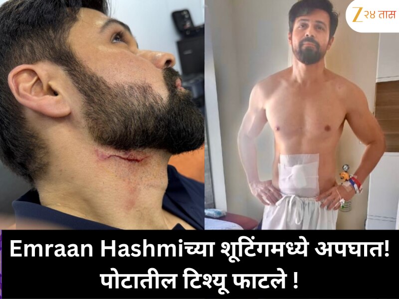 शूटिंग दरम्यान Emraan Hashmi सोबत मोठा अपघात! पोटातील टिश्यू फाटले, काय कारण होतं?