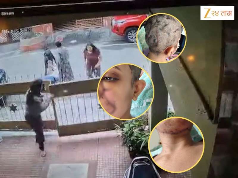 कुत्र्याचा इतका भयानक हल्ला तुम्ही कधीच पाहिला नसेल, तरुणीच्या तोंड, गळा आणि पायावर 50 टाके, पहा VIDEO