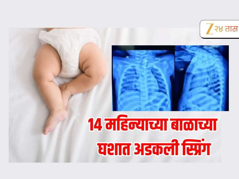 14 महिन्याच्या बाळाच्या घशात अडकली 1/2 इंच स्प्रिंग, डॉक्टरांनी... 