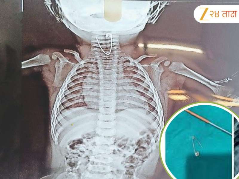 तान्ह्या बाळाच्या घश्यात अडकली सेफ्टी पिन; पुढे काय झालं? जाणून घ्या